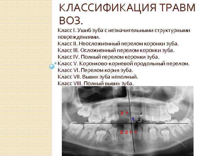 КЛАССИФИКАЦИЯ ТРАВМ ВОЗ. Класс I. Ушиб зуба с незначительными структурными повреждениями. Класс II. Неосложненный