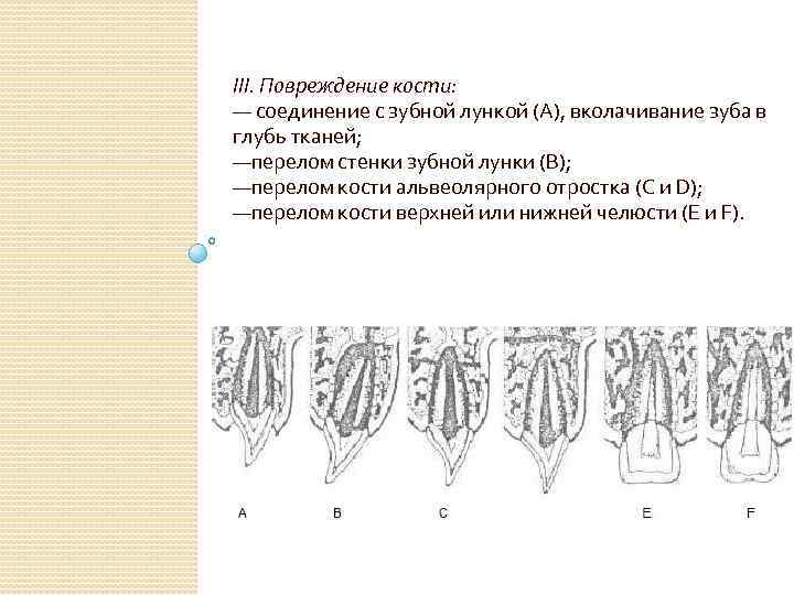 III. Повреждение кости: — соединение с зубной лункой (А), вколачивание зуба в глубь тканей;