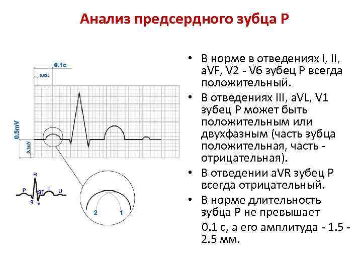 Анализ экг. Зубец p на ЭКГ v1. Отрицательный зубец p в v1 v2 отведении. Отрицательный зубец р в 1 отведении. V1 ЭКГ деформирован отрицательный зубец.