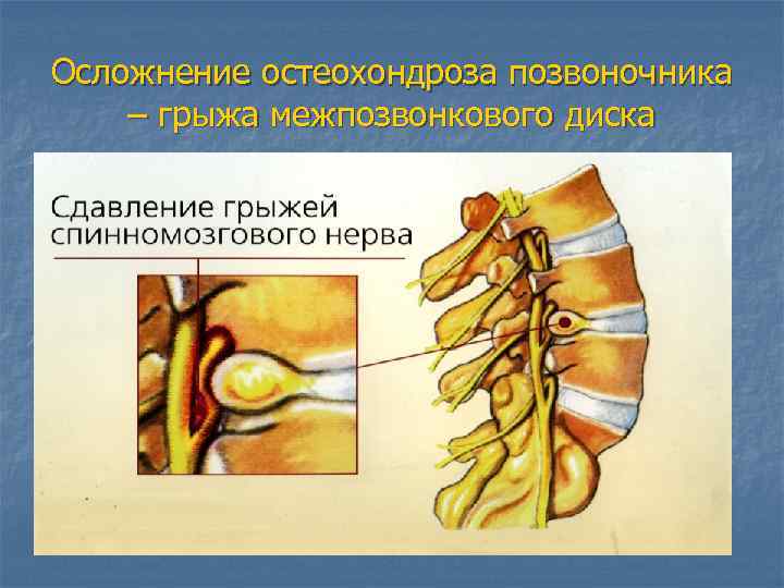 Осложнение остеохондроза позвоночника – грыжа межпозвонкового диска 