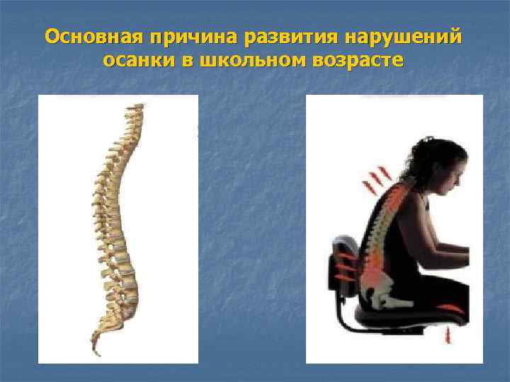 Основная причина развития нарушений осанки в школьном возрасте 