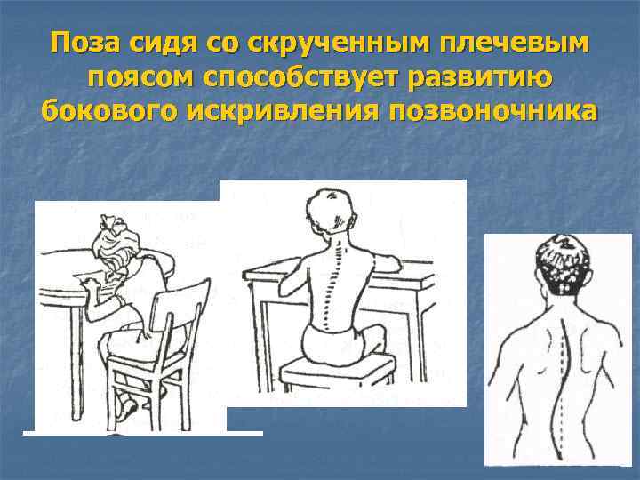 Поза сидя со скрученным плечевым поясом способствует развитию бокового искривления позвоночника 