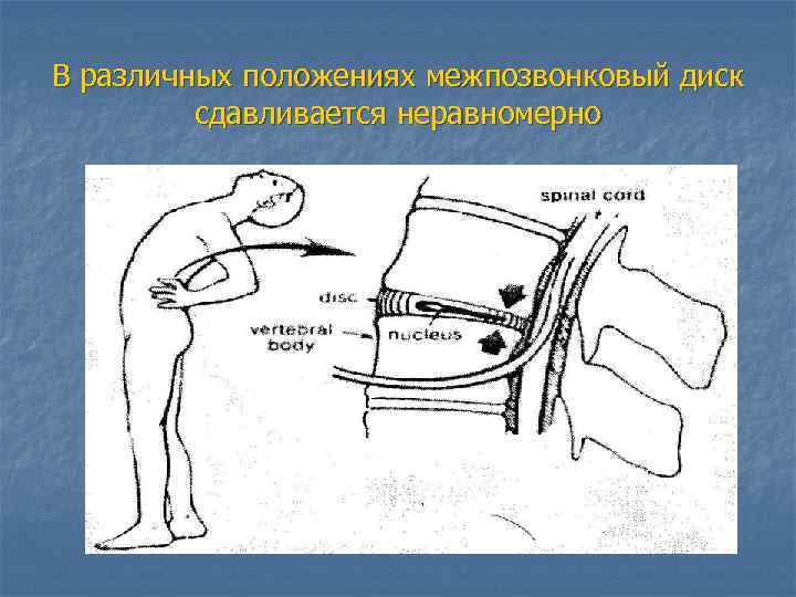 В различных положениях межпозвонковый диск сдавливается неравномерно 