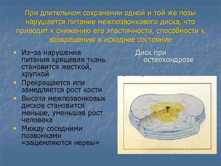 При длительном сохранении одной и той же позы нарушается питание межпозвонкового диска, что приводит