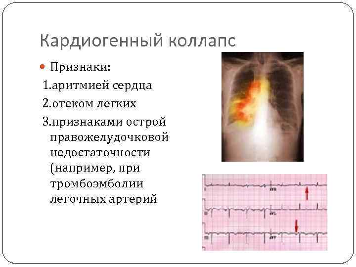 Коллапс легкого это. Кардиогенный коллапс. Кардиогенный коллапс характеризуется. Кардиогенный коллапс этиология. Коллапс сердца симптомы.