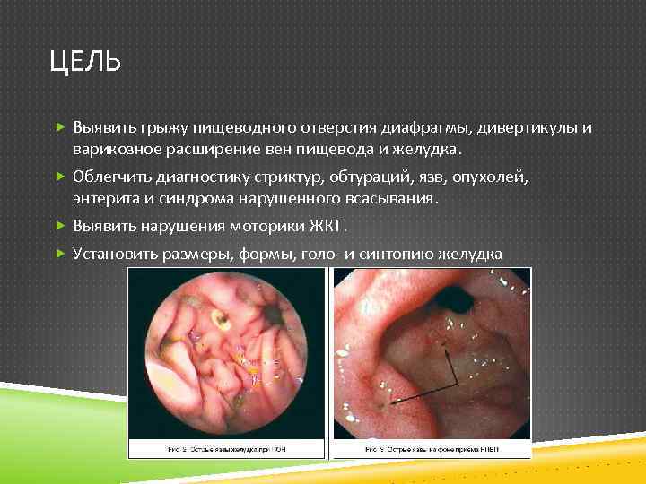 ЦЕЛЬ Выявить грыжу пищеводного отверстия диафрагмы, дивертикулы и варикозное расширение вен пищевода и желудка.