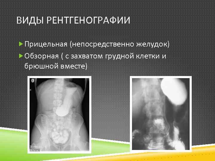 ВИДЫ РЕНТГЕНОГРАФИИ Прицельная (непосредственно желудок) Обзорная ( с захватом грудной клетки и брюшной вместе)