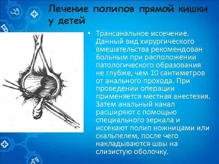 Лечение полипов прямой кишки у детей • Трансанальное иссечение. Данный вид хирургического вмешательства рекомендован