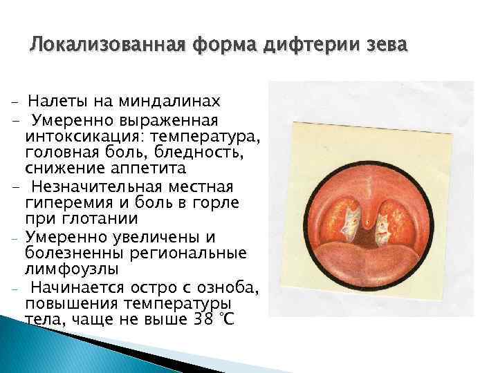 Локализованная форма дифтерии зева Налеты на миндалинах - Умеренно выраженная интоксикация: температура, головная боль,