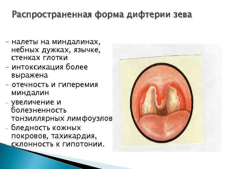 Распространенная форма дифтерии зева - налеты на миндалинах, небных дужках, язычке, стенках глотки -