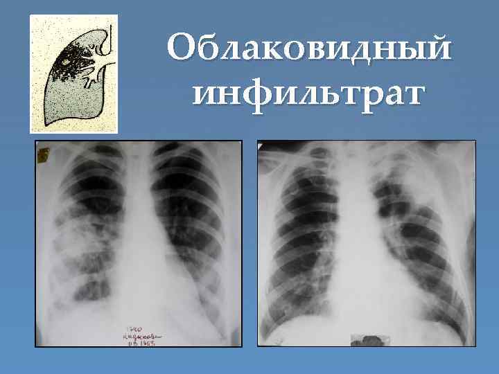 Облаковидный инфильтрат 