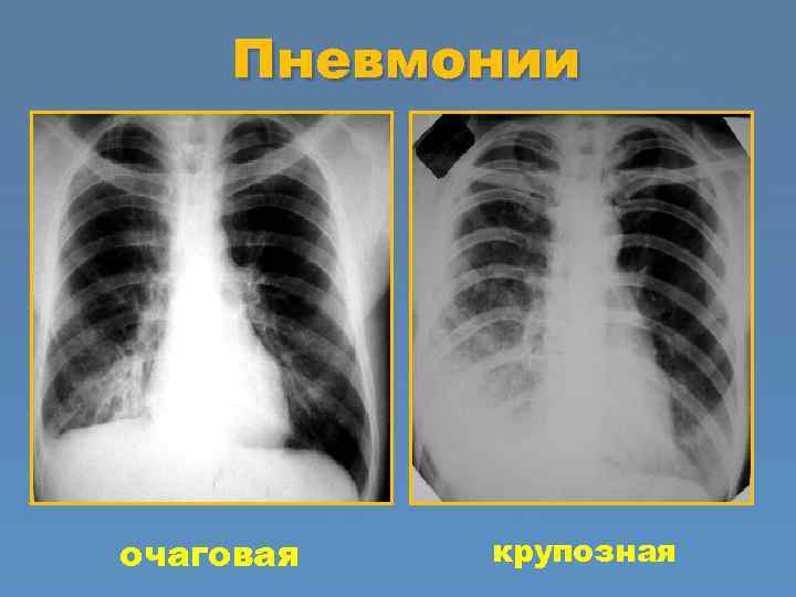 Пневмонии очаговая крупозная 