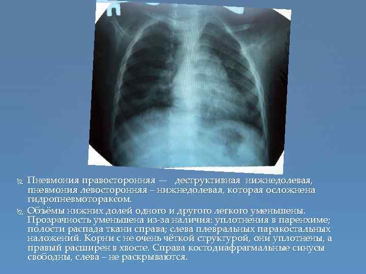  Пневмония правосторонняя — деструктивная нижнедолевая, пневмония левосторонняя – нижнедолевая, которая осложнена гидропневмотораксом. Объёмы