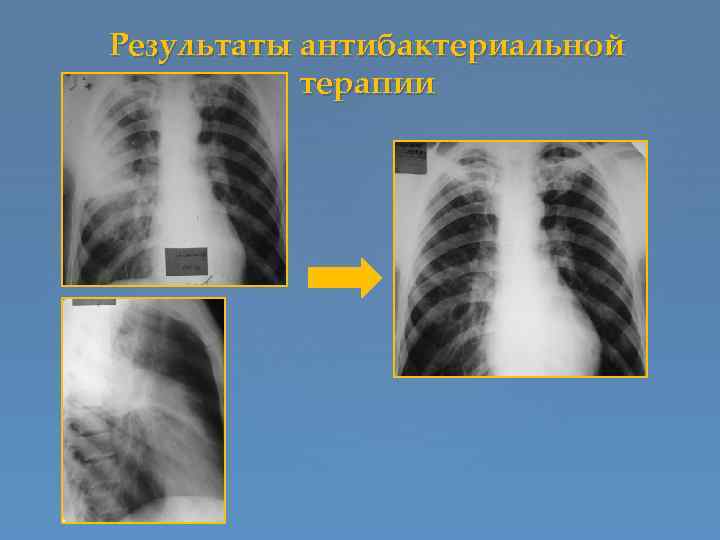 Результаты антибактериальной терапии 