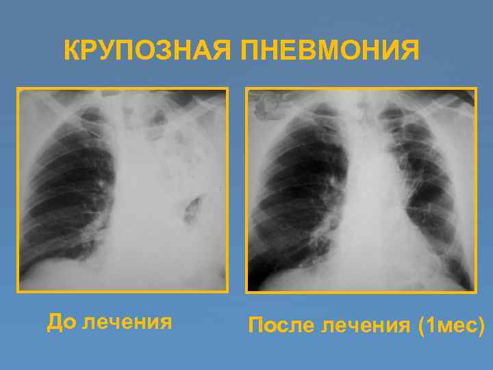 КРУПОЗНАЯ ПНЕВМОНИЯ До лечения После лечения (1 мес) 