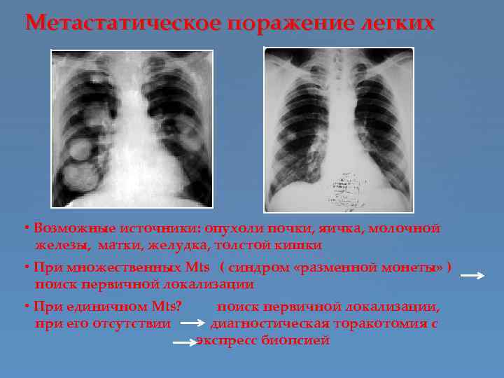 Метастатическое поражение легких • Возможные источники: опухоли почки, яичка, молочной железы, матки, желудка, толстой