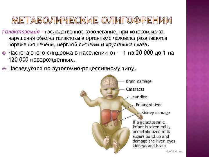 Гала ктоземи я - наследственное заболевание, при котором из-за нарушения обмена галактозы в организме