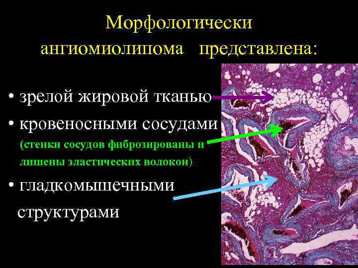 Морфологически ангиомиолипома представлена: • зрелой жировой тканью • кровеносными сосудами (стенки сосудов фиброзированы и