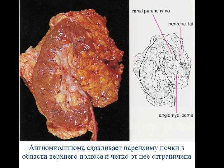 Ангиомиолипома сдавливает паренхиму почки в области верхнего полюса и четко от нее отграничена 