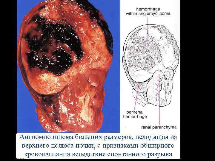 Ангиомиолипома больших размеров, исходящая из верхнего полюса почки, с признаками обширного кровоизлияния вследствие спонтанного