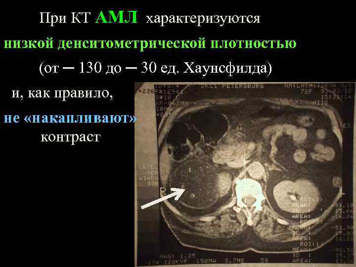 При КТ АМЛ характеризуются низкой денситометрической плотностью (от ─ 130 до ─ 30 ед.