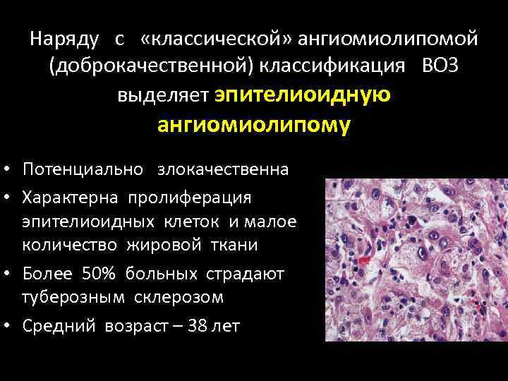 Наряду с «классической» ангиомиолипомой (доброкачественной) классификация ВОЗ выделяет эпителиоидную ангиомиолипому • Потенциально злокачественна •