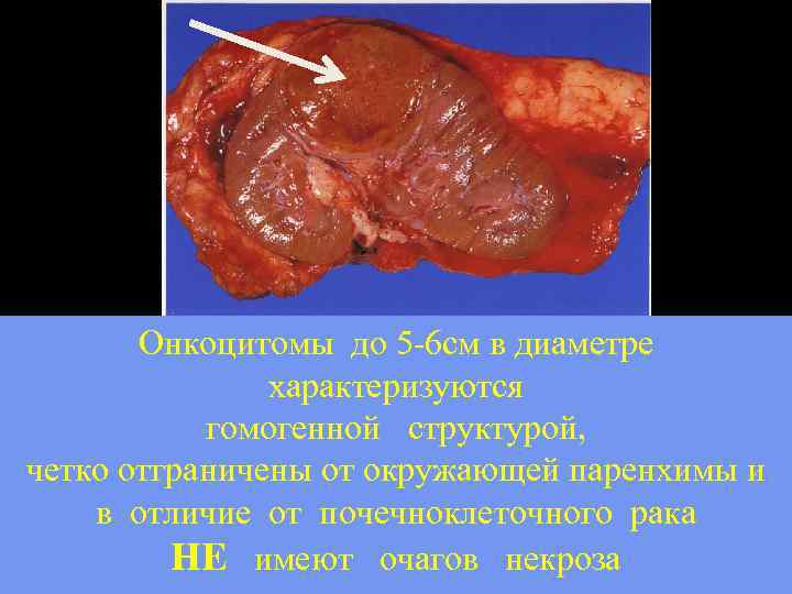 Онкоцитомы до 5 -6 см в диаметре характеризуются гомогенной структурой, четко отграничены от окружающей