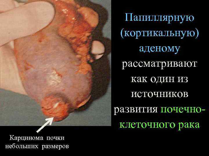 Папиллярную (кортикальную) аденому рассматривают как один из источников развития почечноклеточного рака Карцинома почки небольших