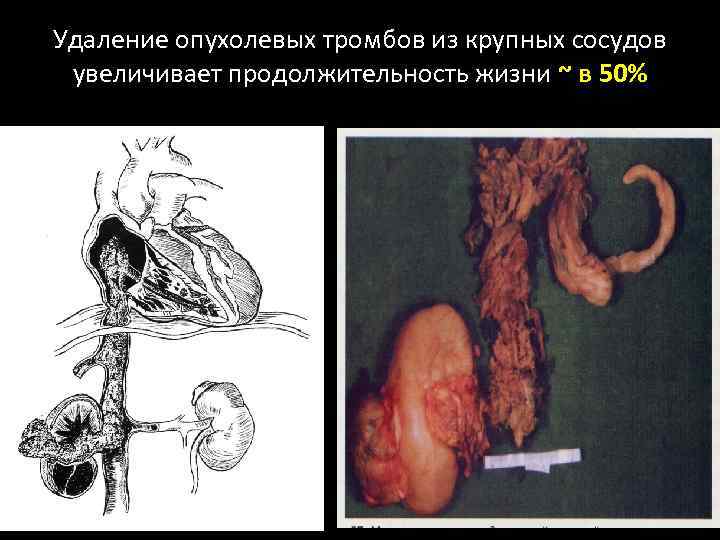 Удаление опухолевых тромбов из крупных сосудов увеличивает продолжительность жизни ~ в 50% 