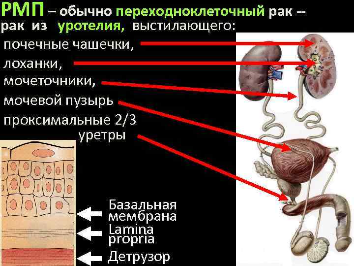 РМП – обычно переходноклеточный рак -рак из уротелия, выстилающего: почечные чашечки, лоханки, мочеточники, мочевой