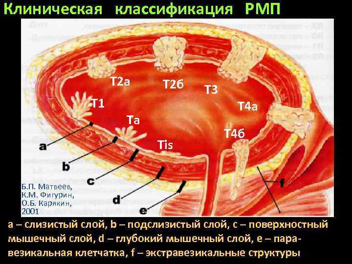 Клиническая классификация РМП T 2 a T 1 T 2 б Ta Tis T