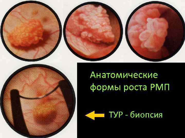 Анатомические формы роста РМП ТУР - биопсия 