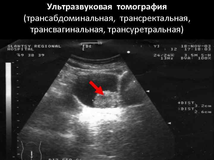 Ультразвуковая томография (трансабдоминальная, трансректальная, трансвагинальная, трансуретральная) 