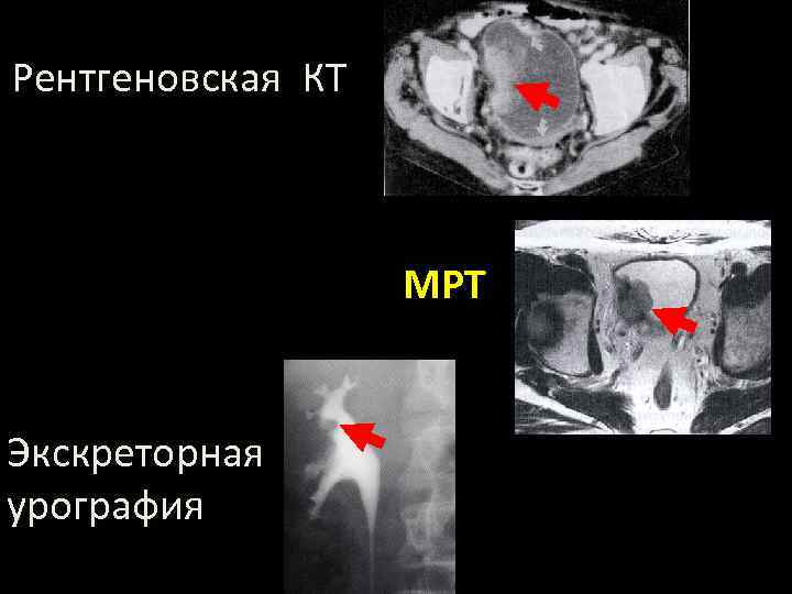 Рентгеновская КТ МРТ Экскреторная урография 