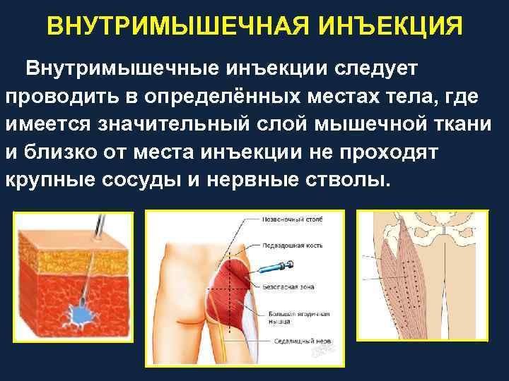 ВНУТРИМЫШЕЧНАЯ ИНЪЕКЦИЯ Внутримышечные инъекции следует проводить в определённых местах тела, где имеется значительный слой