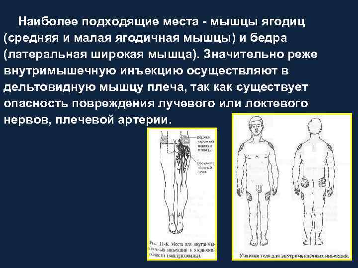 Наиболее подходящие места мышцы ягодиц (средняя и малая ягодичная мышцы) и бедра (латеральная широкая