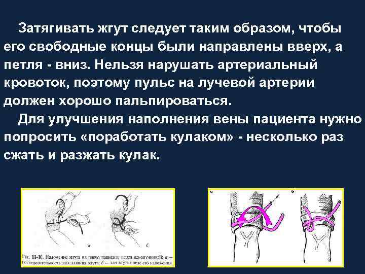 Затягивать жгут следует таким образом, чтобы его свободные концы были направлены вверх, а петля