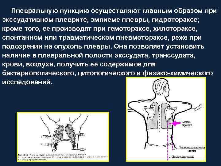 Экссудативный плеврит пункция