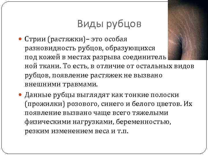 Виды рубцов Стрии (растяжки)– это особая разновидность рубцов, образующихся под кожей в местах разрыва