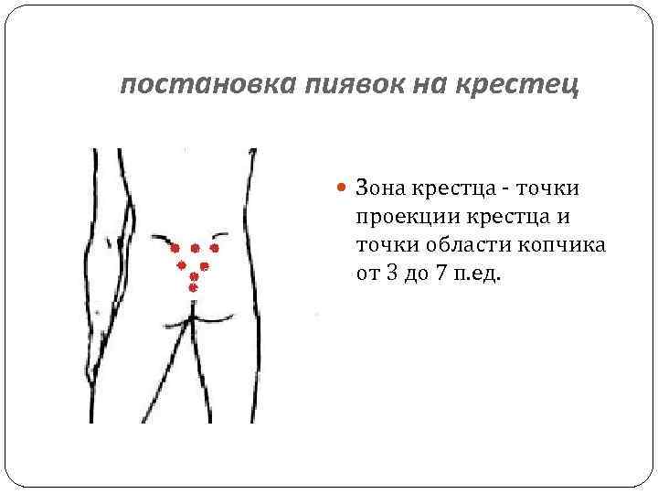 Ставим пиявки на крестец схема