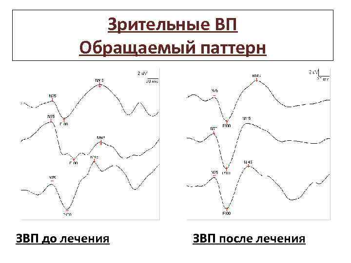 Зрительные ВП Обращаемый паттерн ЗВП до лечения ЗВП после лечения 