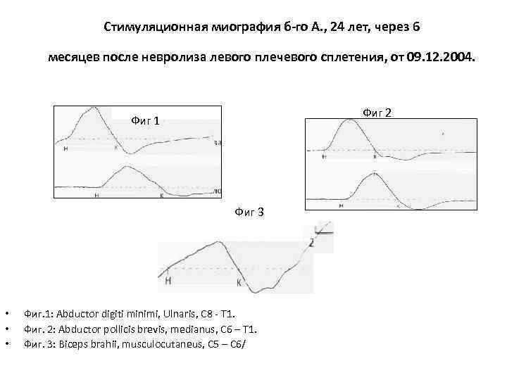 Стимуляционная миография б-го А. , 24 лет, через 6 месяцев после невролиза левого плечевого