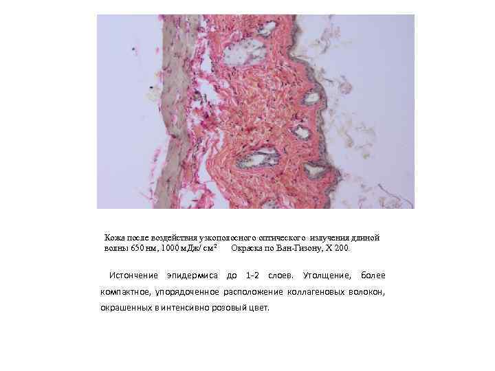 Кожа после воздействия узкополосного оптического излучения длиной волны 650 нм, 1000 м. Дж/ см