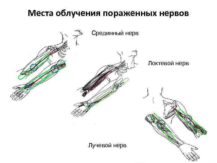 Места облучения пораженных нервов » Срединный нерв » Локтевой нерв Лучевой нерв 64 