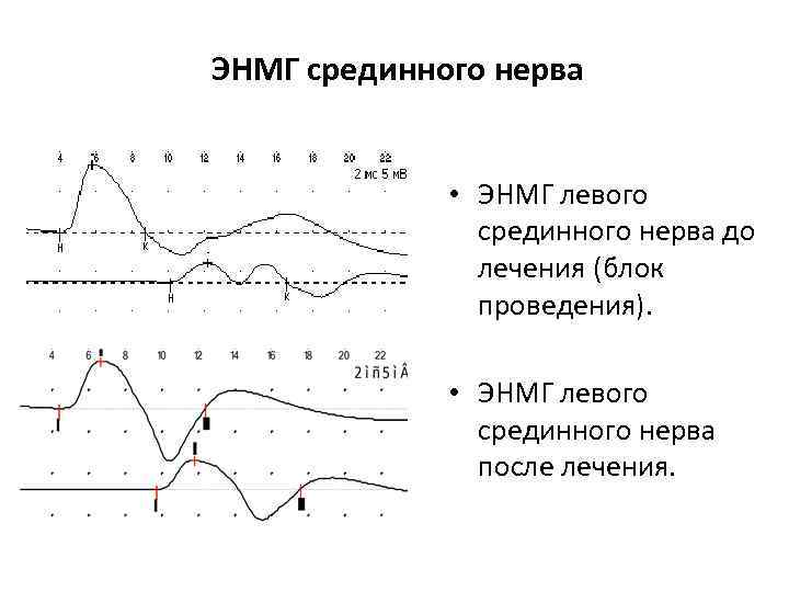 ЭНМГ срединного нерва • ЭНМГ левого срединного нерва до лечения (блок проведения). • ЭНМГ