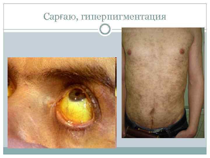 Сарғаю, гиперпигментация 