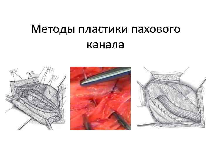 Методы пластики пахового канала 