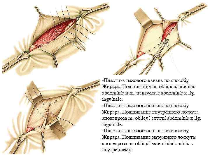 -Пластика пахового канала по способу Жирара. Подшивание m. obliquus internus abdominis и m. transversus