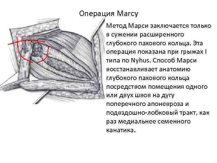 Операция Marcy • Метод Марси заключается только в сужении расширенного глубокого пахового кольца. Эта