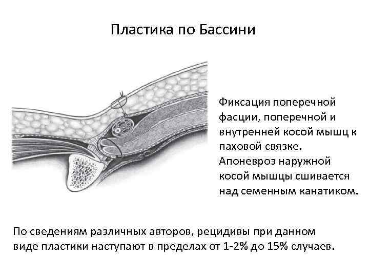 Пластика по Бассини Фиксация поперечной фасции, поперечной и внутренней косой мышц к паховой связке.